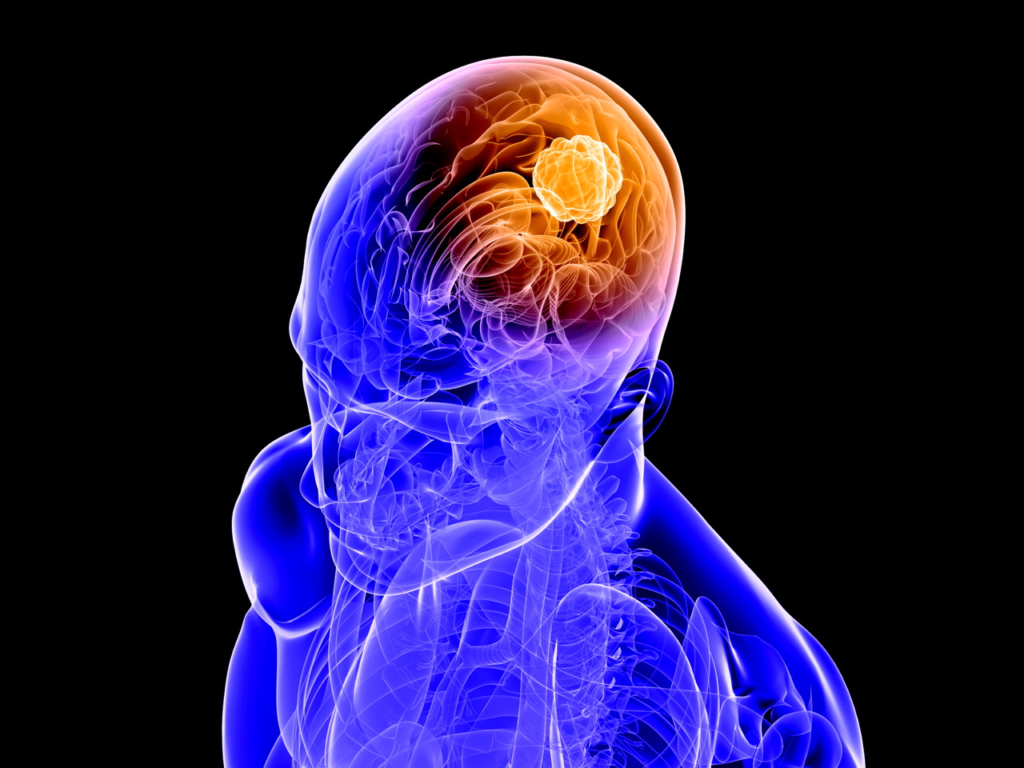 What is a brain glioma and its prognosis?