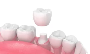 Dental Crowns