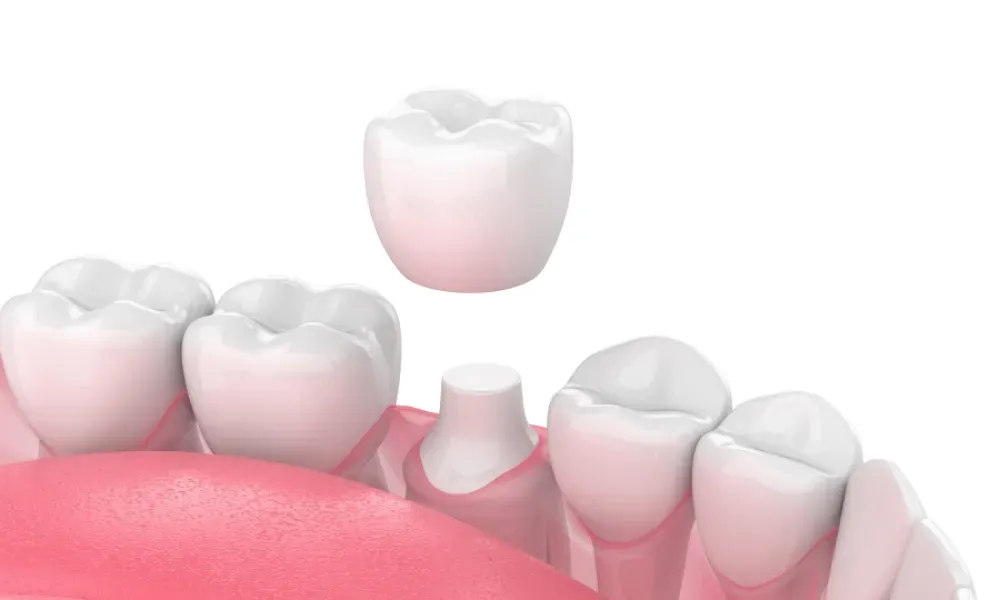 Dental Crowns